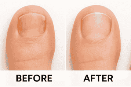 WellaNail nail fungus care before and after